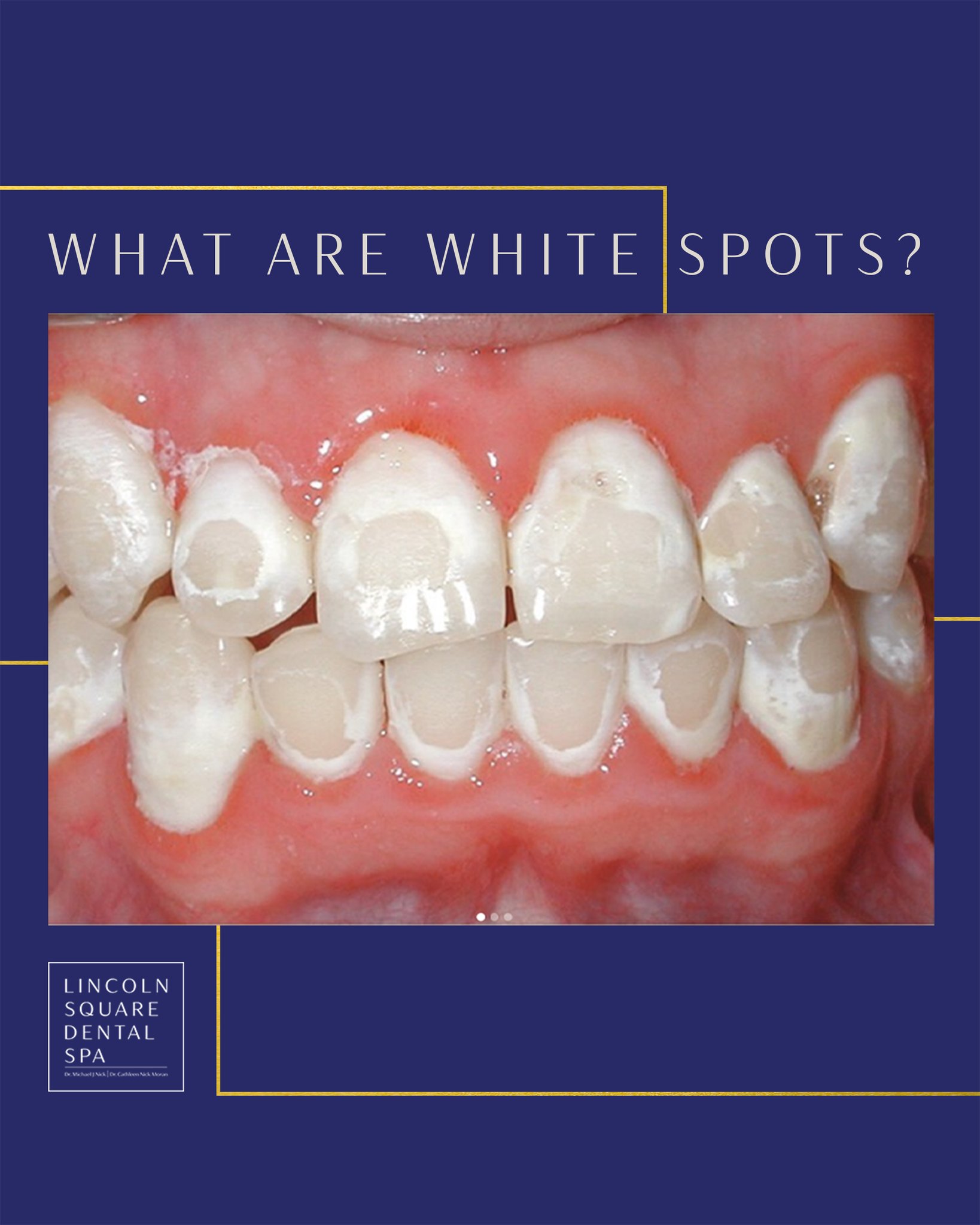 glutathione side effects teeth decalcification White spots on your teeth? These might be areas, which are the first sign your enamel is losing minerals. Common causes: plaque, braces, sugary foods, low fluoride, and more! They're mostly 🚨 Everyone's yelling BPC-157 Preference:Gluten-Free Vegan Eye Cream