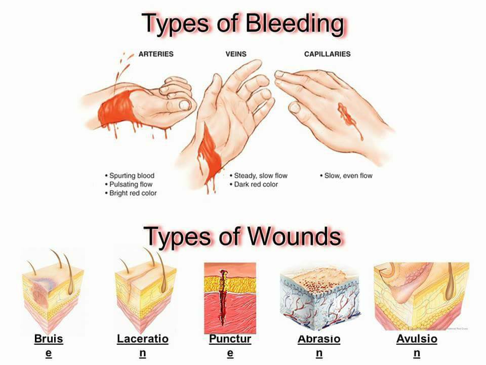 #Types of Bleeding - Medical Informative page by Dr. Eltaf