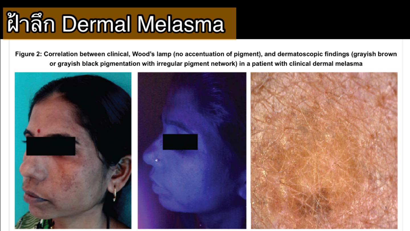 📍ฝ้ามีกี่ชนิด Melasma Type ปัญหาเรื่อง “ฝ้า (Melasma หรือ Cholasma ...
