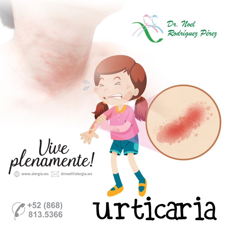 👉 La urticaria consiste en áreas de la piel rojas e inflamadas (ronchas ...