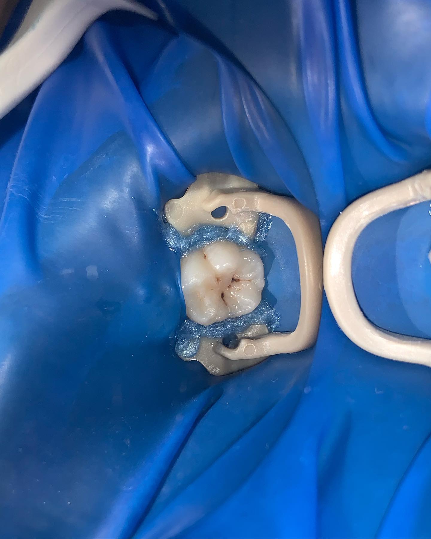 Operatoria dental 🦷 en paciente... - C.D. Kermith Diaz Mena