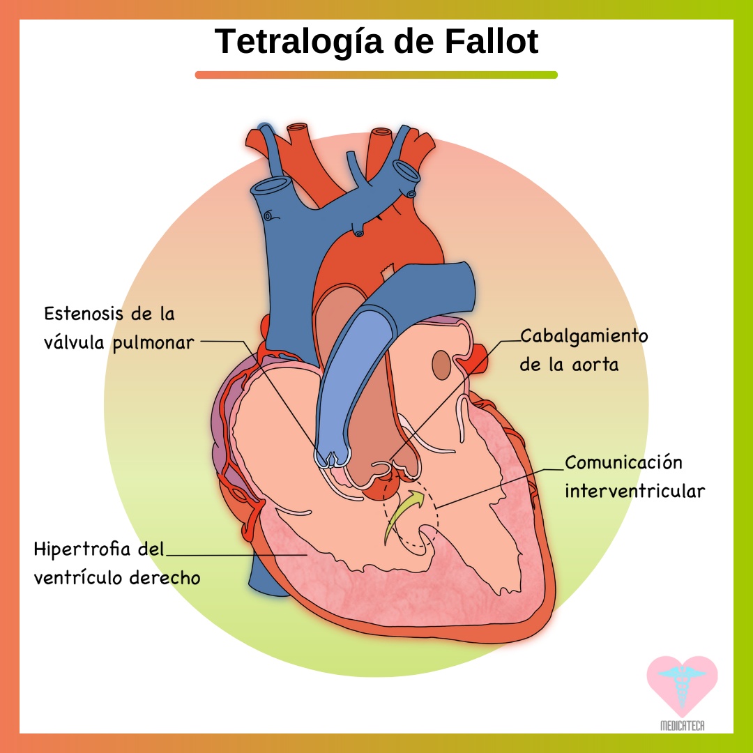 Medicateca - 💚 Tetralogía de Fallot💚 La tetralogía de...