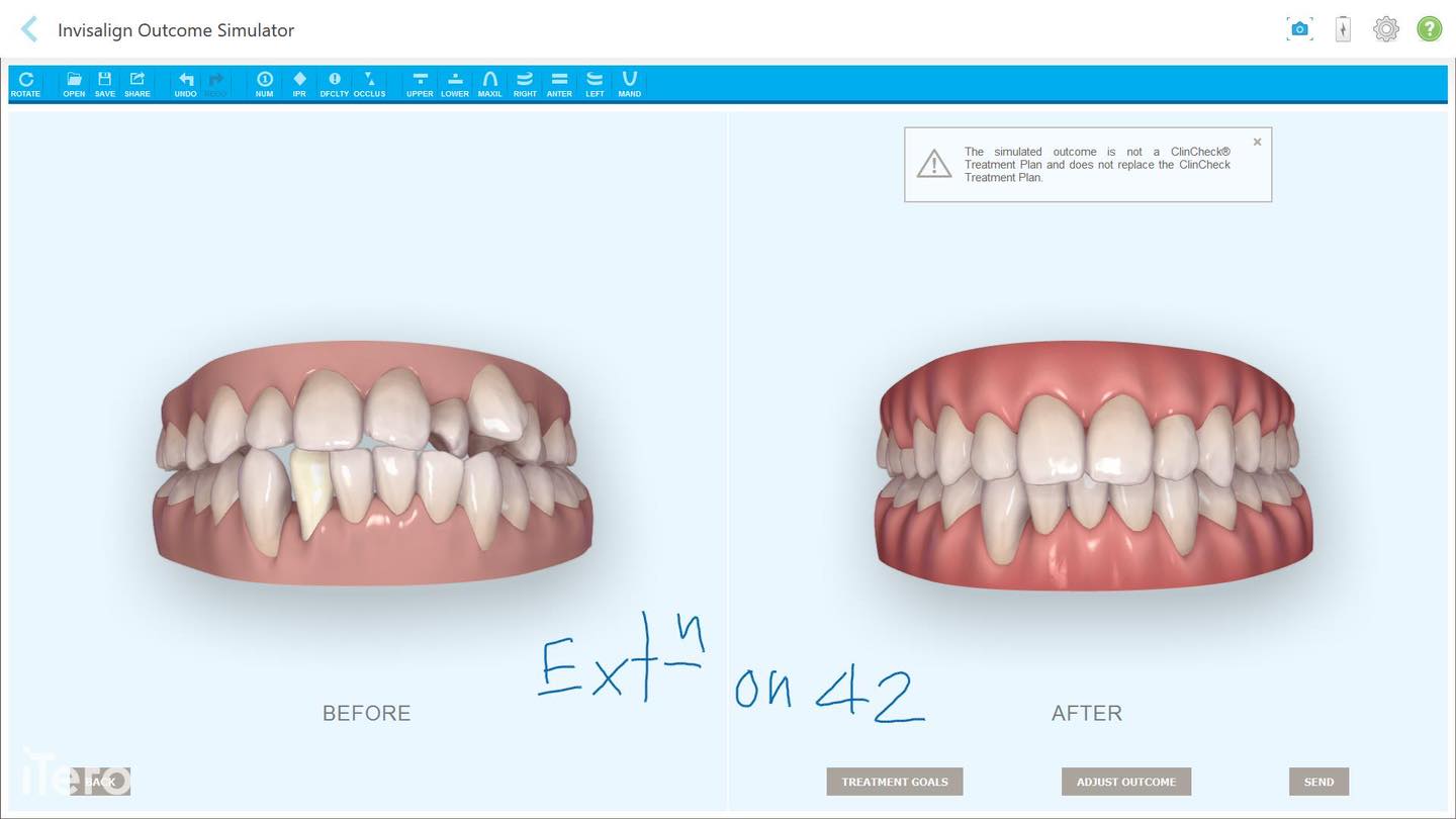 Invisalign รีวิวผลลัพธ์จัดฟันแบบใส ด้วยการ scan ภาพสามมิติด้วยเครื่อง ...