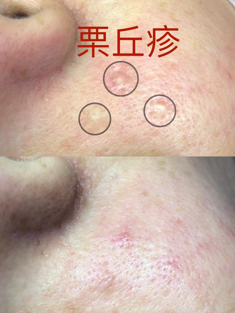 🌟皮膚小知識大學問😆😆😆😆 👉🏻脂肪粒、栗丘疹？是什麼東東... - 幸福美妍坊～文玲Tiffany老師 | Facebook