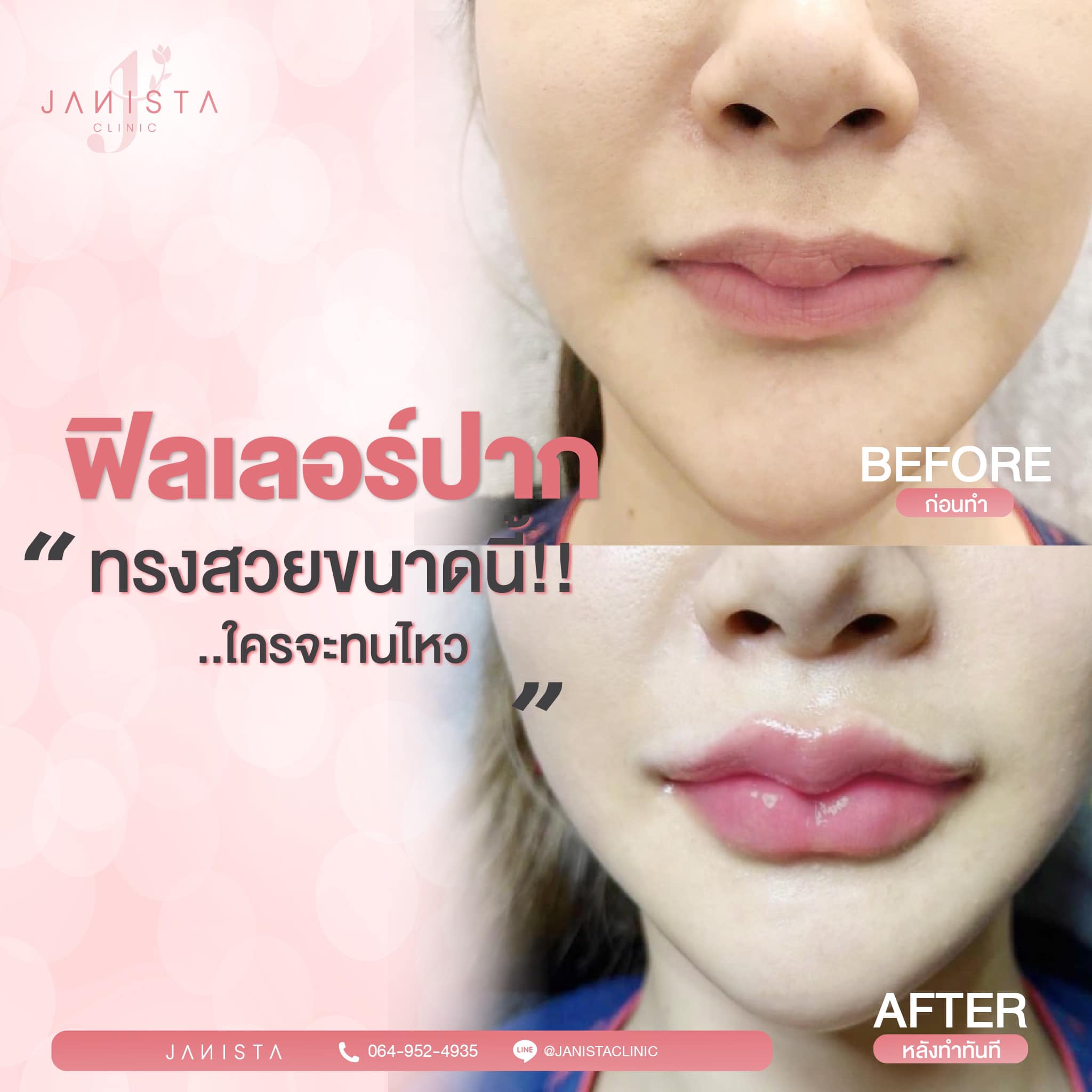 ทรงปากสวยจนไม่ทน ... - Janista Clinic - สาขาเชียงใหม่ | Facebook