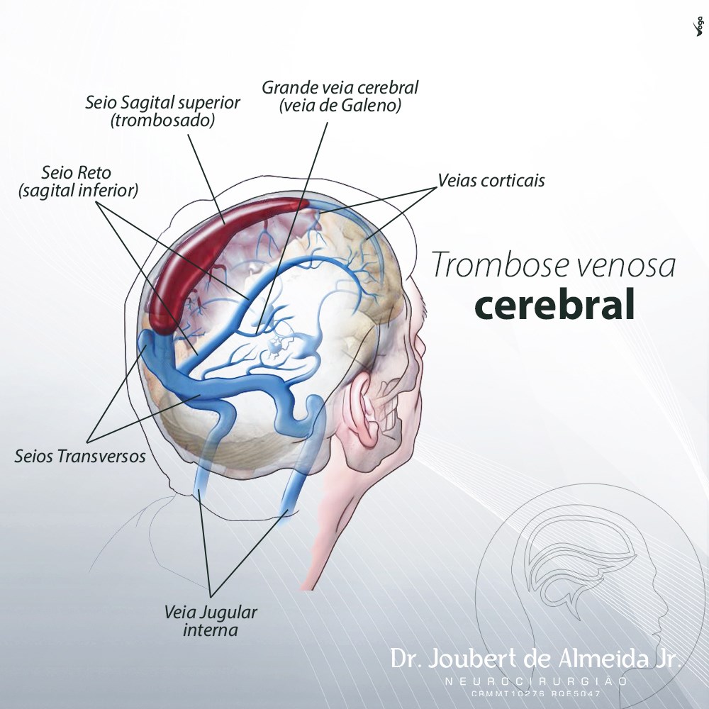 dr-joubert-almeida-jr-trombose-venosa-cerebral-tvc-uma-doen-a