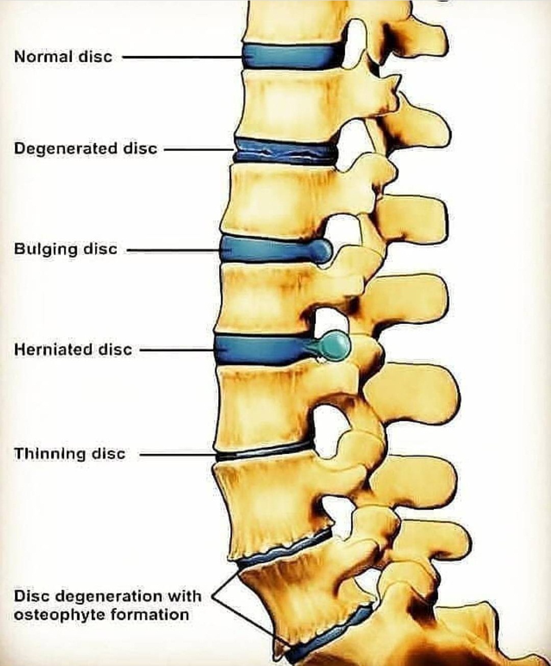 Types of disc degeneration - Medical Infograph | Facebook