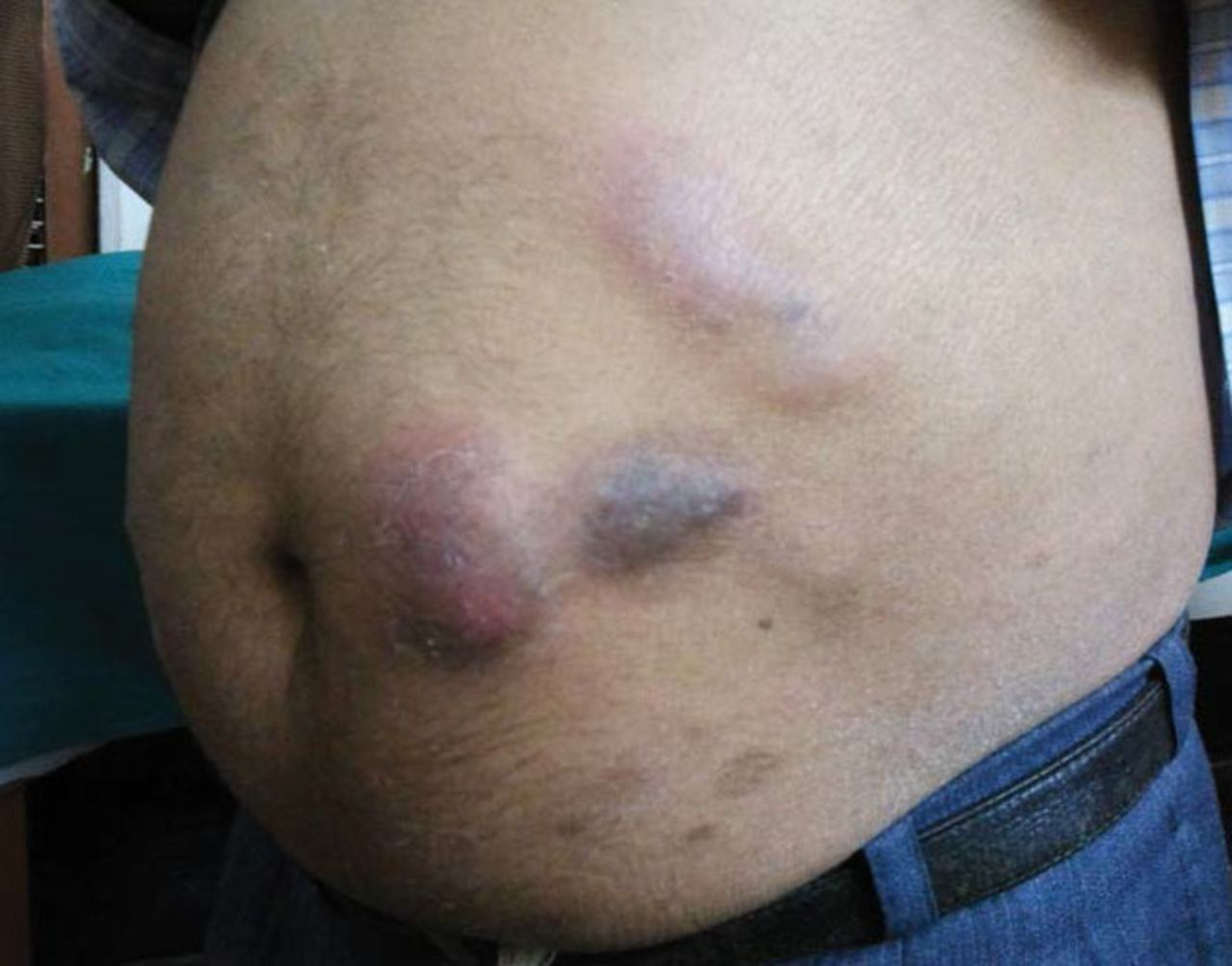 lump under skin from b12 injection site Is the injection-induced bump my normal? An appropriate technique ensures that insulin is injected into the fat tissue and not just under the skin, which is the actual cause for where to buy b12 injections Retatrutide Not Working? 21 Select Your Start Date:14th December