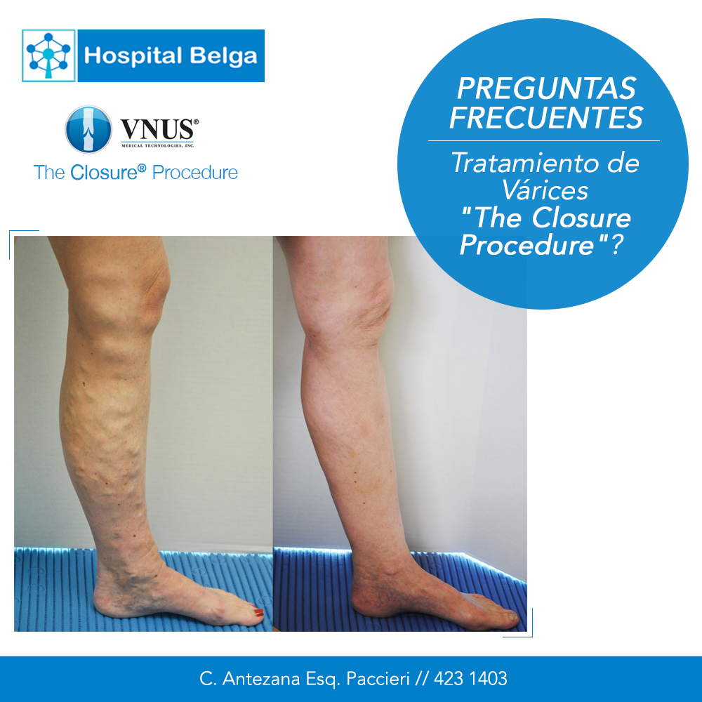 Hospital - Tratamiento de Várices 