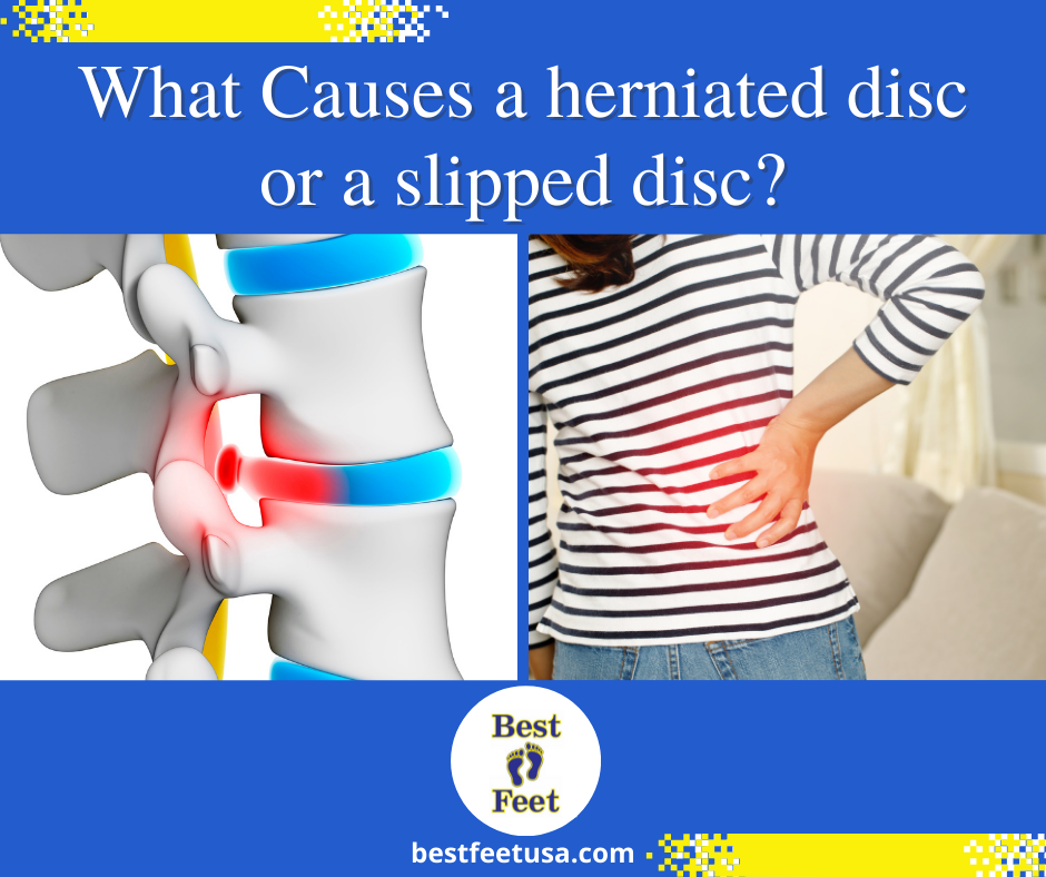 Best Feet - Spinal disc herniation, also known as a herniated disc, is ...