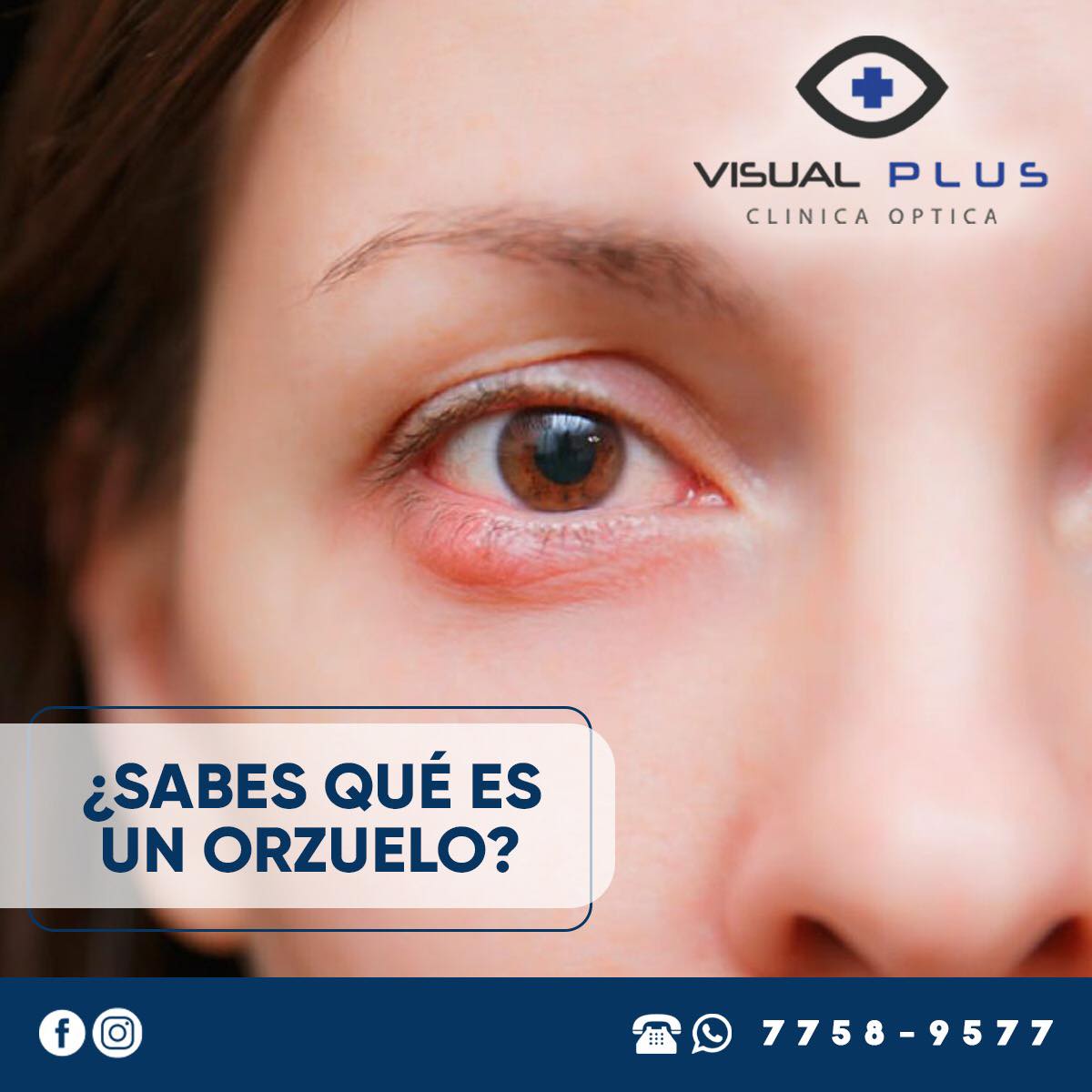 Visual Plus - ¿Sabes que es un orzuelo? 🧐 Un orzuelo es... | Facebook