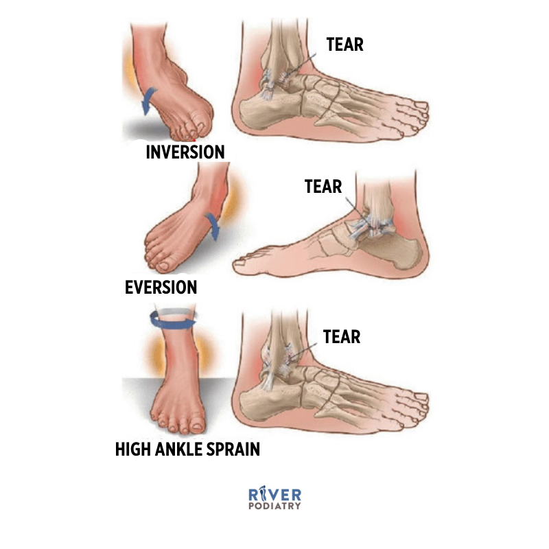 Ankle Sprain Versus Fracture: How To Tell The Difference – ADHI