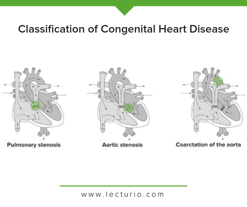 Congenital Heart Defects Diagram