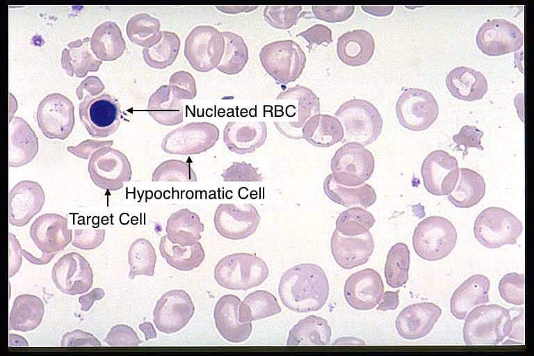 Lab technician - Nucleated Rbc Hypochoromatic Cell Target... | Facebook