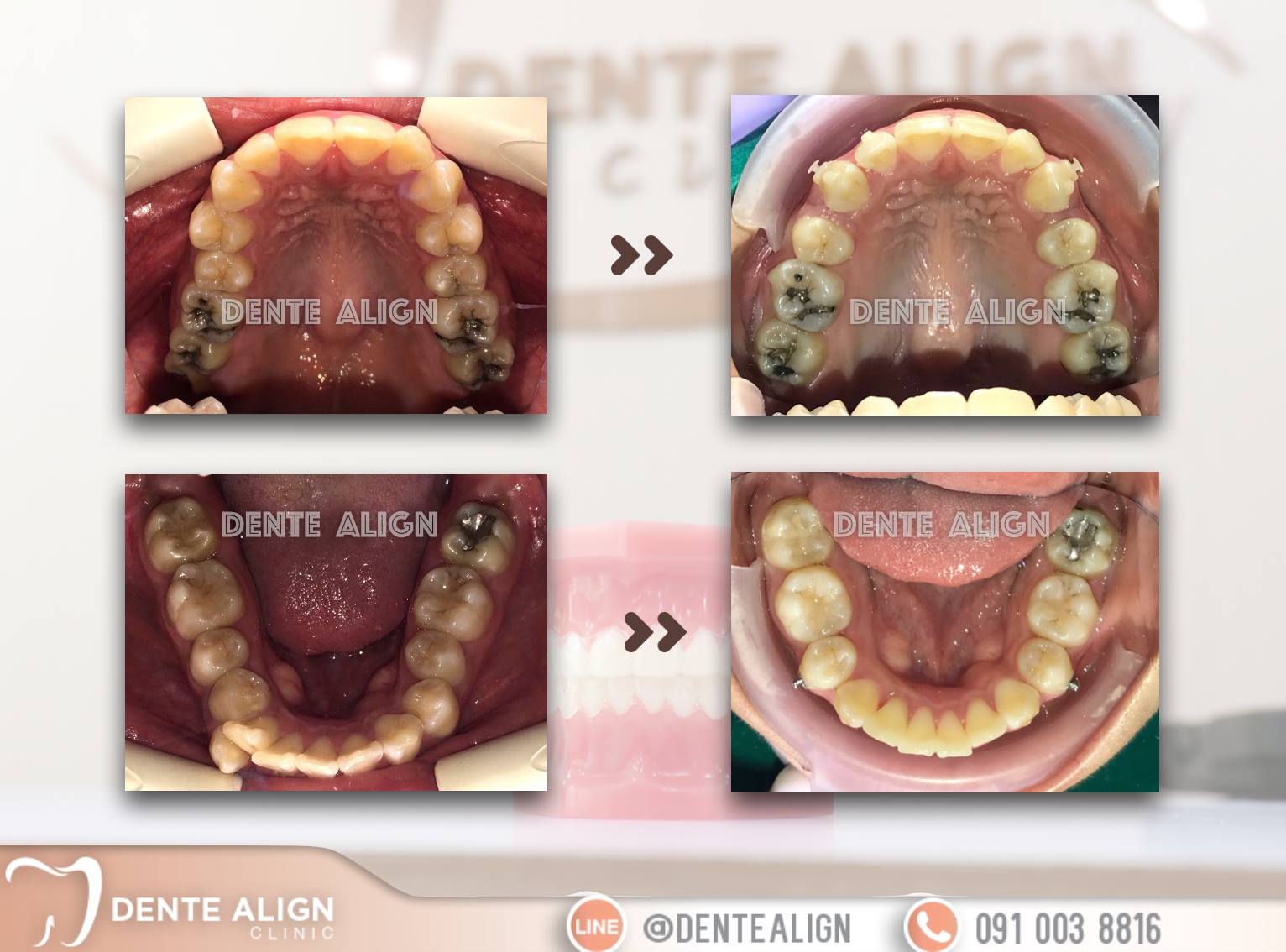 Invisali... - Dente Align Clinic - Invisalign Diamond Provider