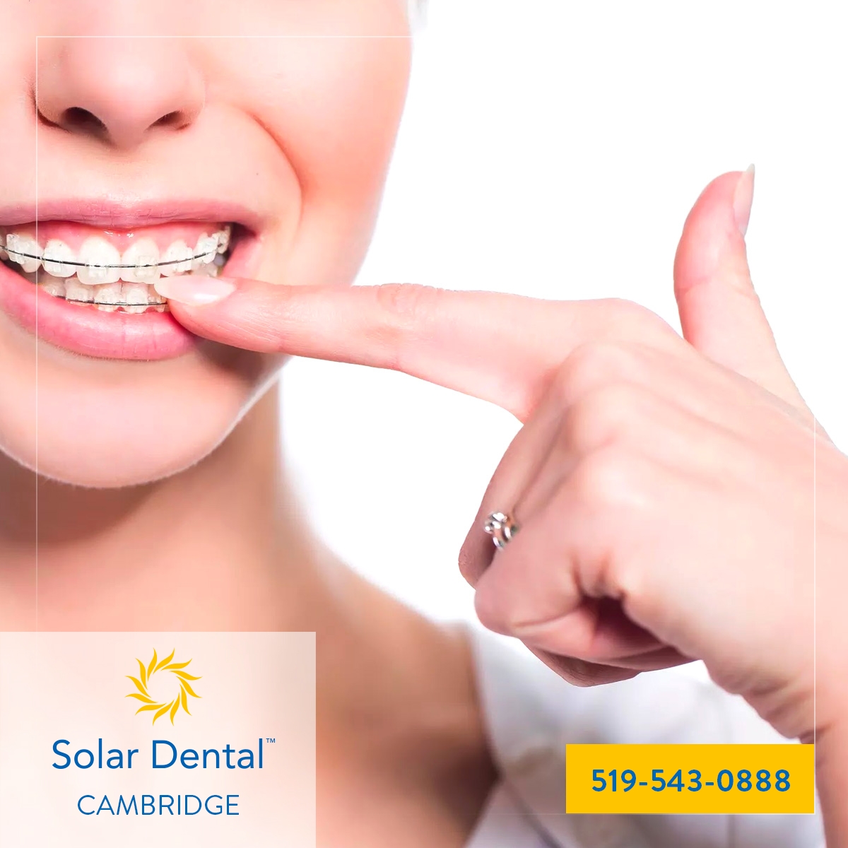 Solar - Braces will not set off metal detectors. It is not possible to ...