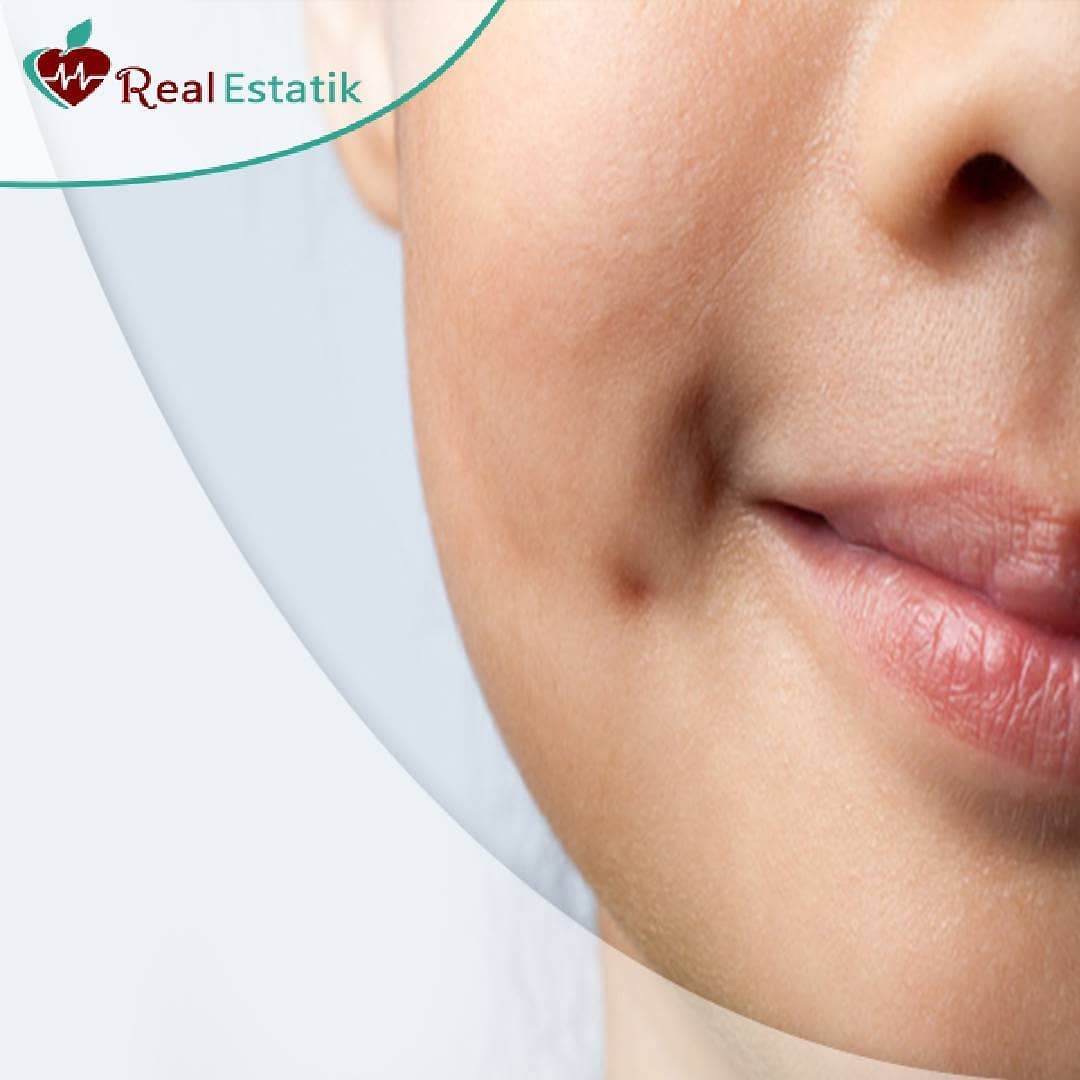 كيف تتم عمليات تجميل غمازات الخدود Realestatikclinic Facebook