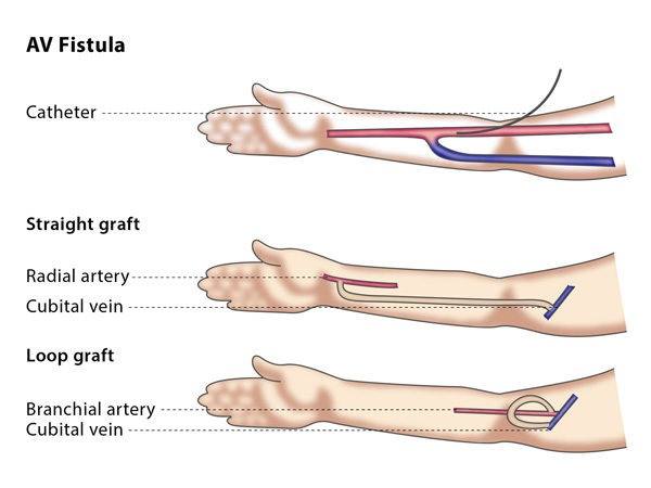 What is an arteriovenous (AV) fistula? An arteriovenous (AV) fistula is ...