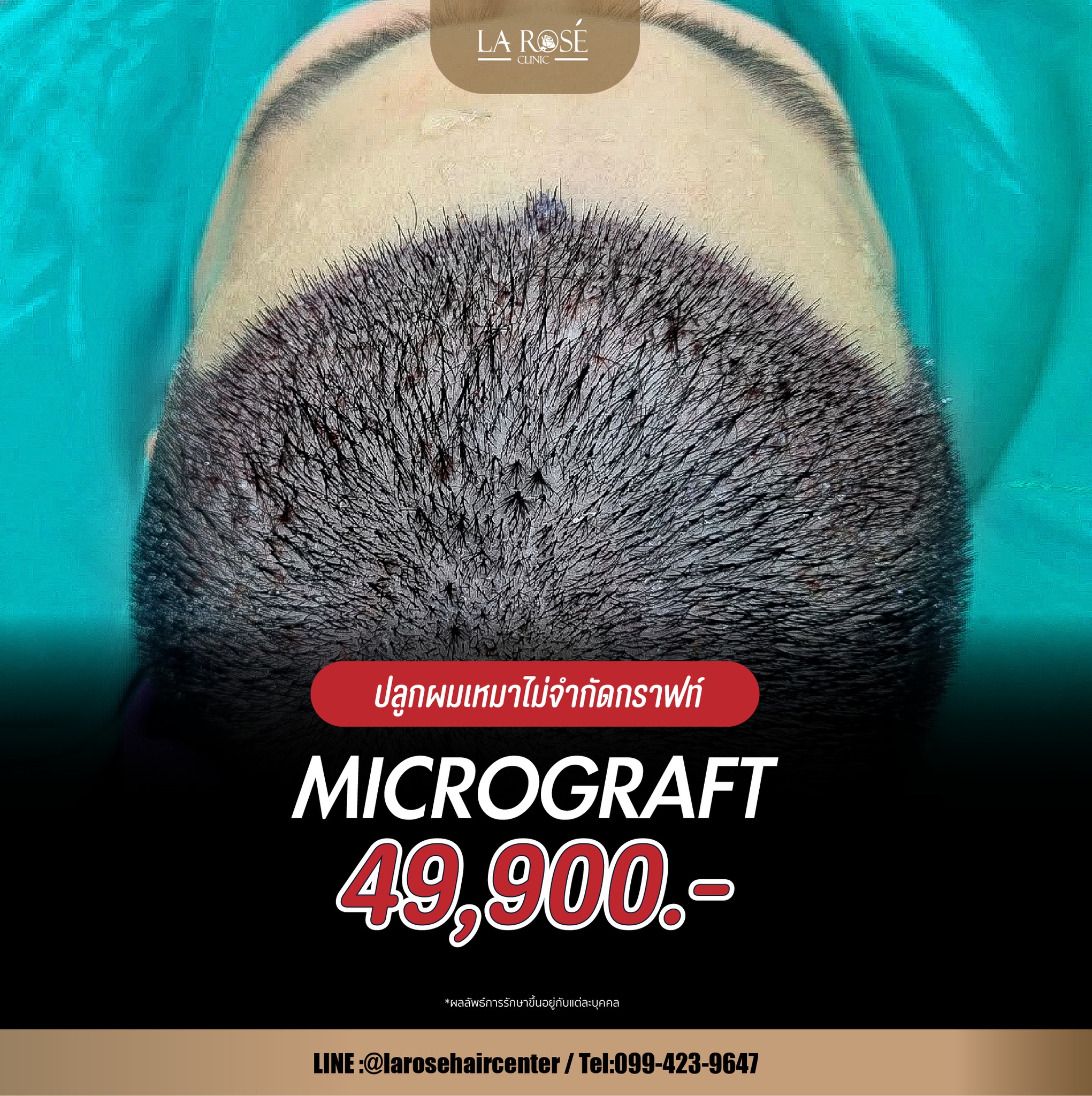 ป... - Larose Clinic Hair Center ปลูกผมถาวร FUE Micrograft DHI