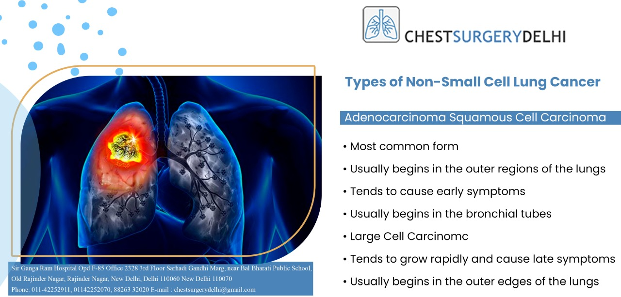 Types of Non-Small Cell Lung Cancer Adenocarcinoma Squamous Cell ...