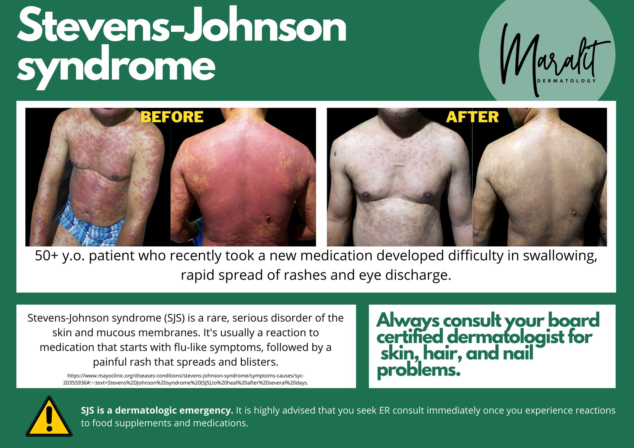 Dr. - ⚠️Stevens-Johnson syndrome is a life-threatening condition. This ...