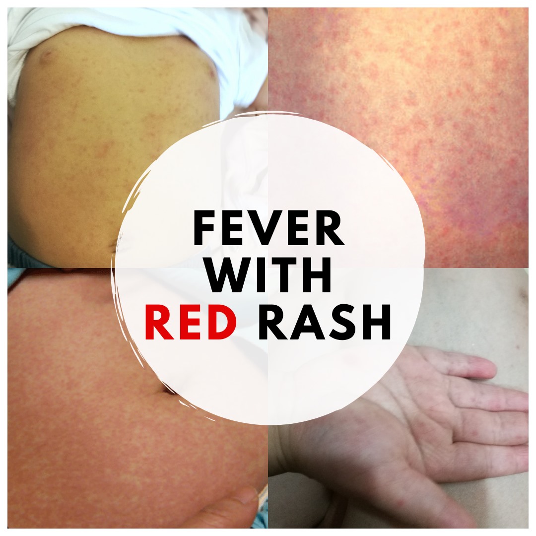 dryikis_crib - | Medic Monday - “Fever with Red Rash”...