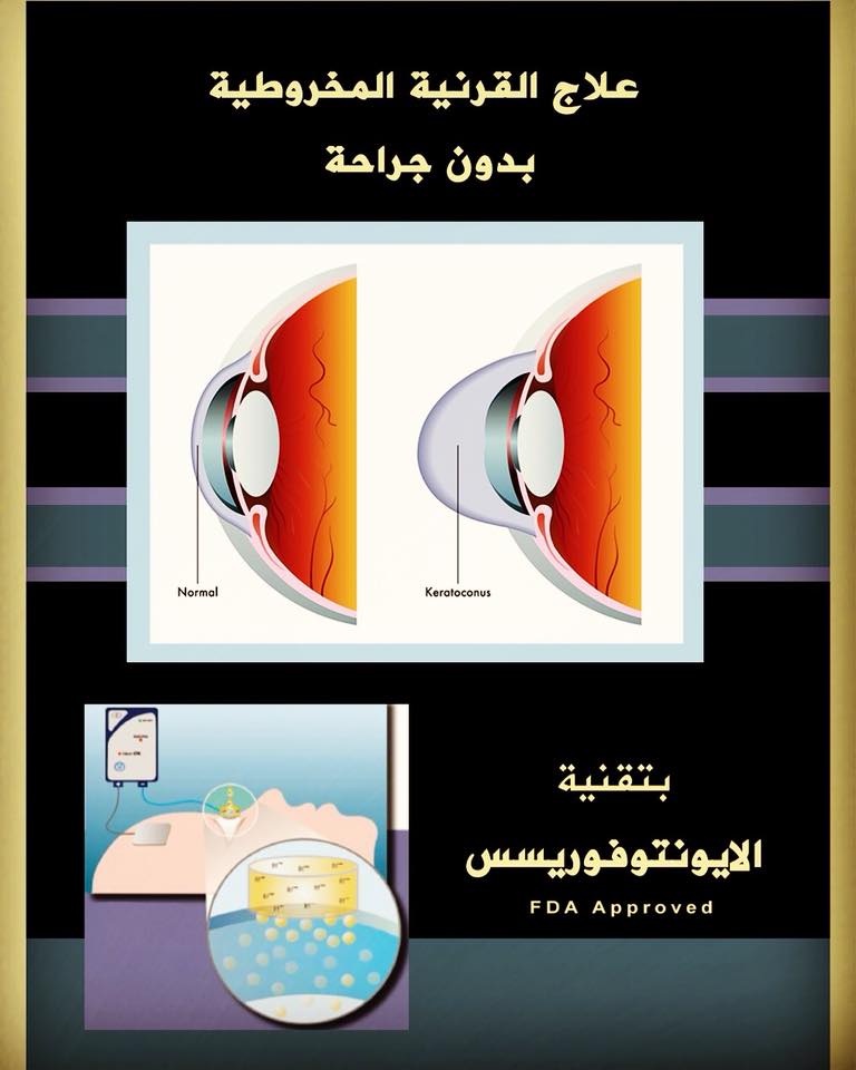 Dr Yazan Marouf Haddadin Eye Clinic إهمال مرض القرنية المخروطية يؤدي الى فقدان جزء كبير من النظر بلا عودة إحجز موعدك الآن و اضمن علاج بدون الم و فترة تعافي سريعة