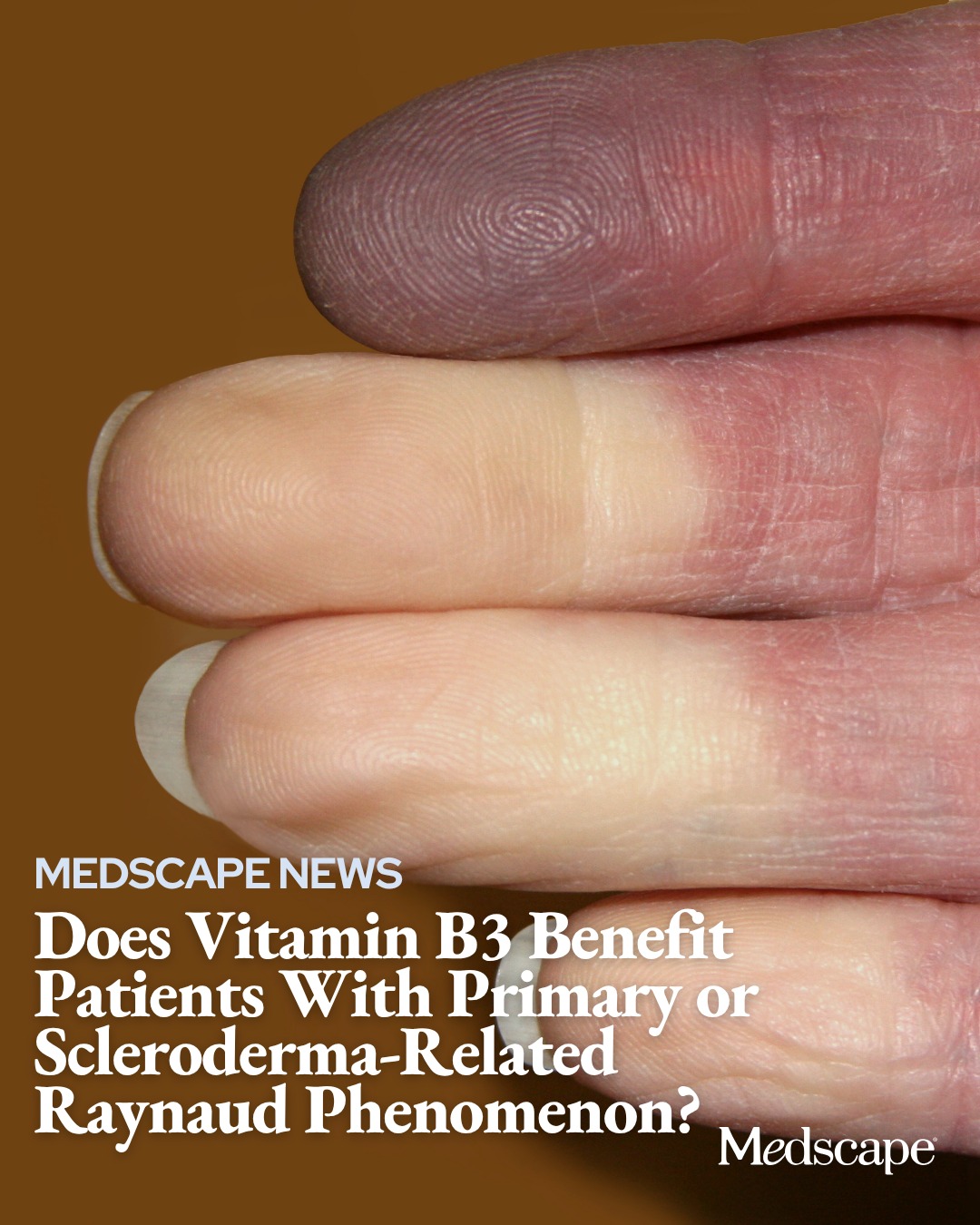 vitamin b12 injection dose medscape Oral B3 (nicotinamide) at 500 mg twice daily for 14 days improved nailfold videocapillaroscopy (NVC) patterns in around 45% of participants with primary or scleroderma-related Raynaud phenomenon (RP), with increased normal research Size:2oz Glass Dropper Bottle Retatrutide Dosage Chart: 12-Week