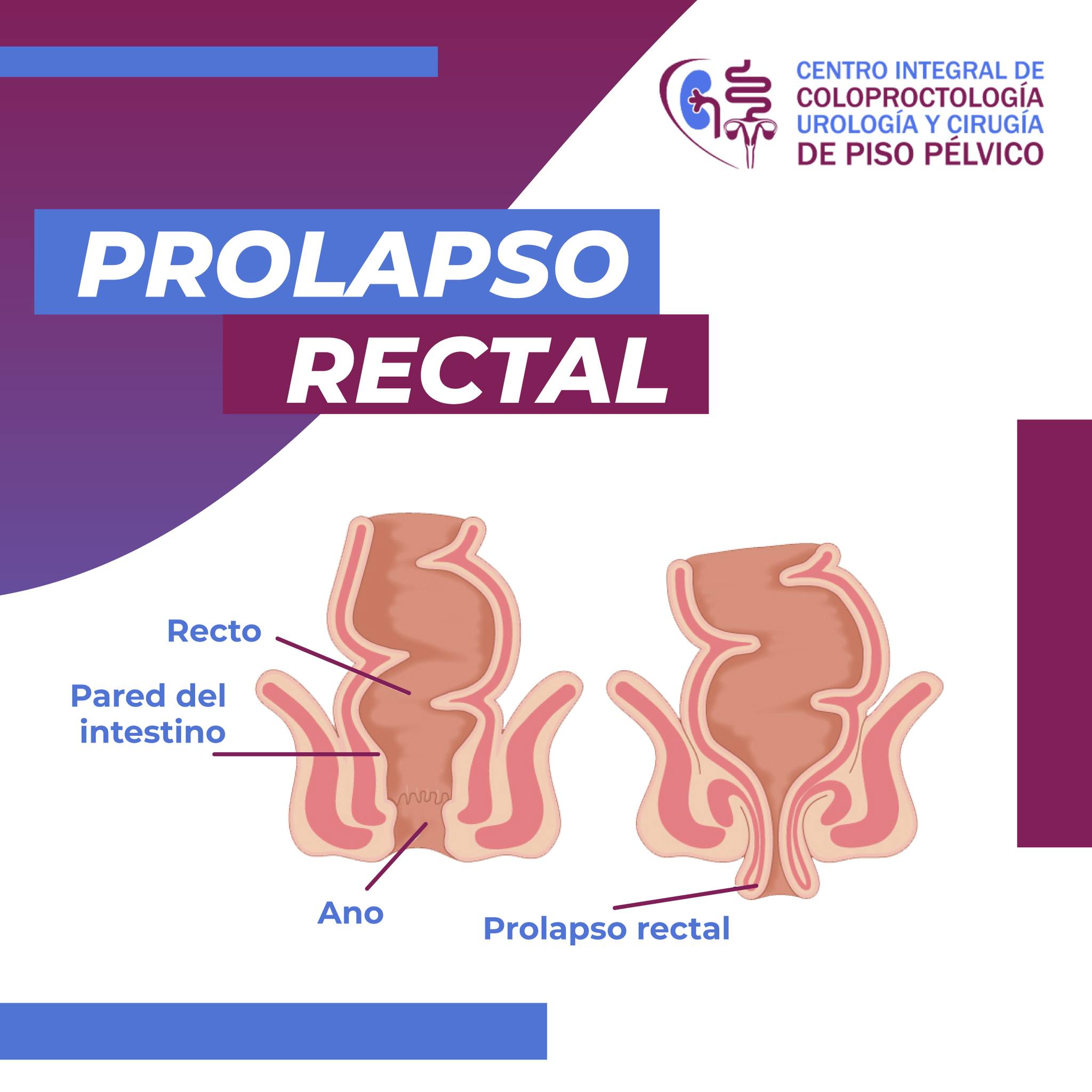 El prolapso rectal... - Proctología y Cirugía de Piso pélvico