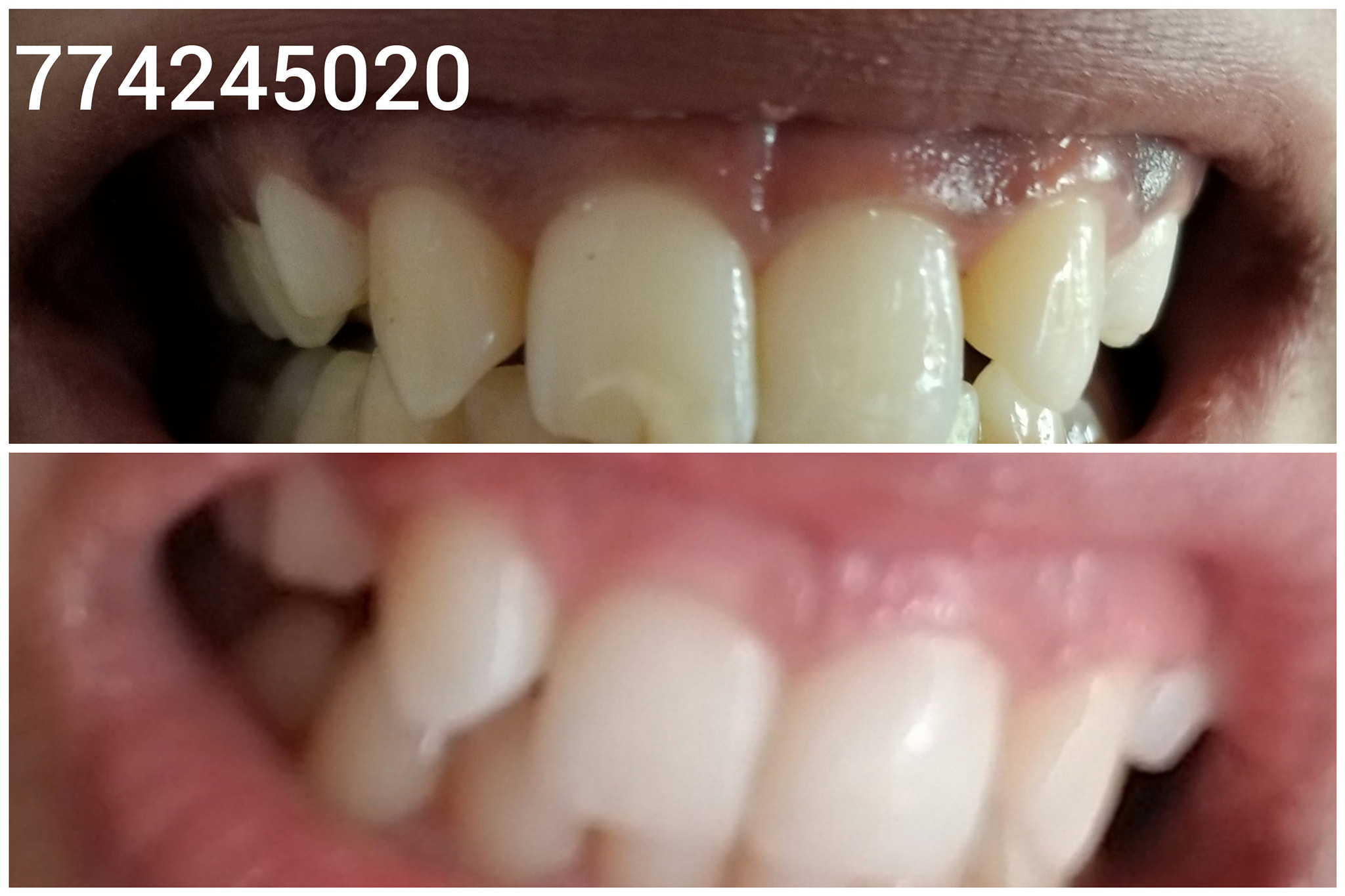 عيادة ثنايا دنت لطب الأسنان - عملية توريد اللثة من الطرق الجمالية ...