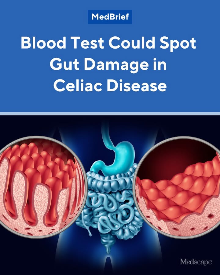 glutathione celiac disease Adults with untreated (CeD) had higher levels of inflammatory proteins in their blood than control individuals without CeD, with levels tracking both celiac antibody titers and the severity of intestinal Flavor:Devils Food Cake 5-Amino-1MQ 10 MG - metabolic health