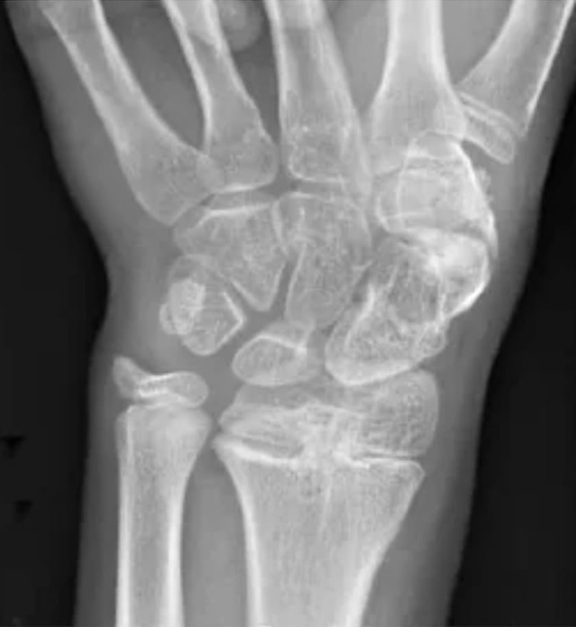 Orthopedic in short notes | Radiographic signs of distal radius growth ...