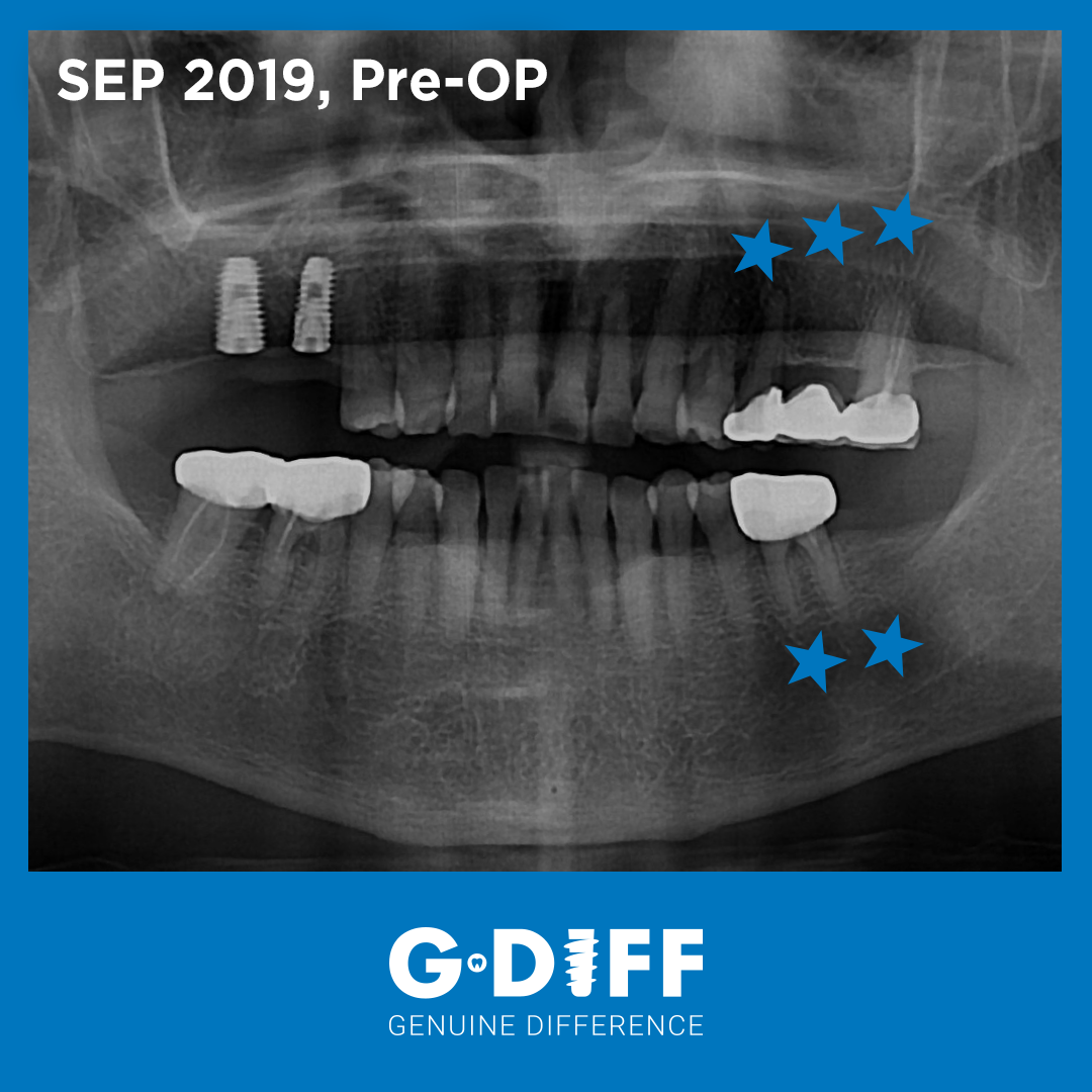 ACH Medical - New Clinical case of G·DIFF (IB-T implant)... | Facebook