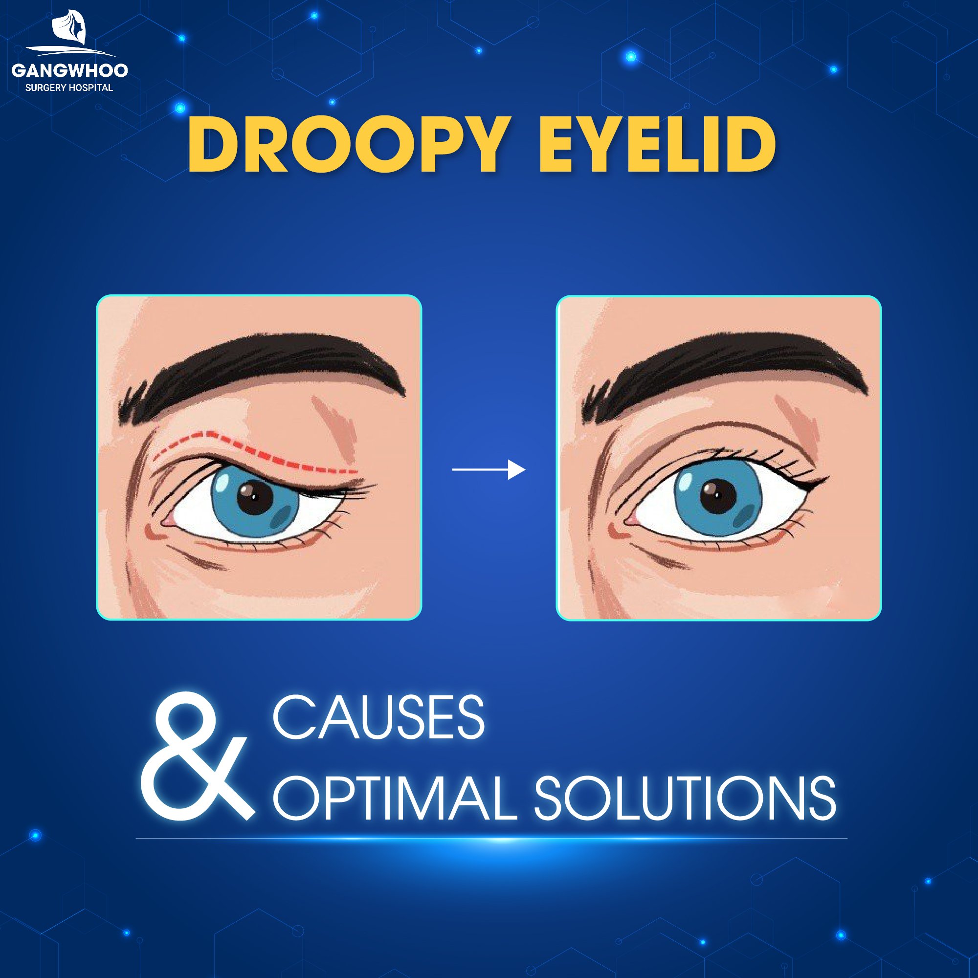 Gangwhoo - DROOPY EYELID: CAUSES AND OPTIMAL SOLUTIONS... | Facebook