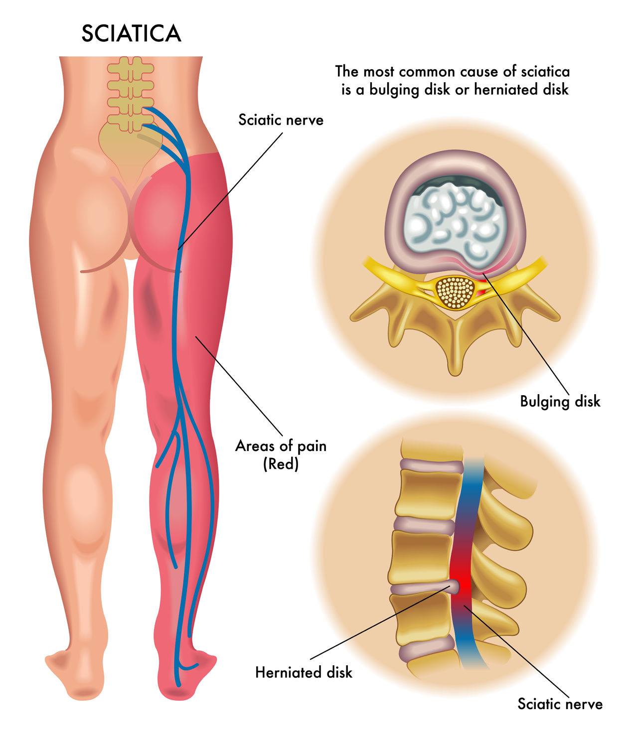 The most distinctive sign of sciatica is pain that radiates from your lower back into the back or side or your legs. How to find relief