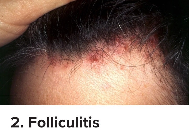 RED SPOTS ON SCALP:... - Calayan Skin Clinic - Lucena City