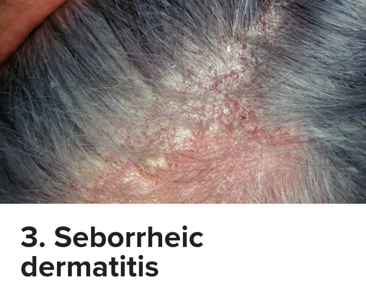 RED SPOTS ON SCALP:... - Calayan Skin Clinic - Lucena City