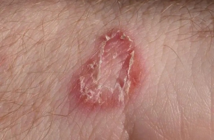 RED SPOTS ON SCALP:... - Calayan Skin Clinic - Lucena City
