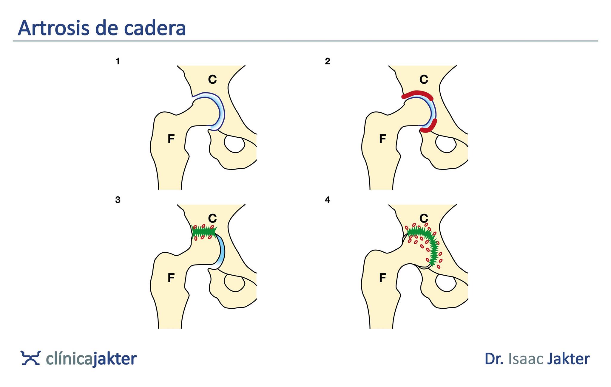 Clínica - ARTROSIS DE CADERA. Cuando hablamos de artrosis, hacemos ...