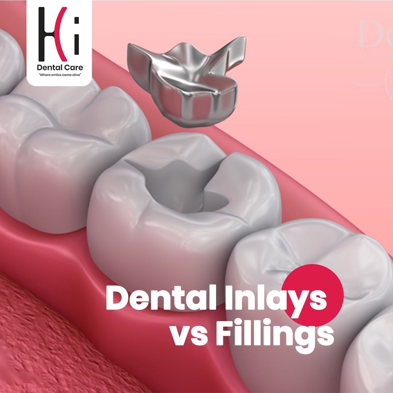 Hi - These two can often be used interchangeably, but inlays are ...