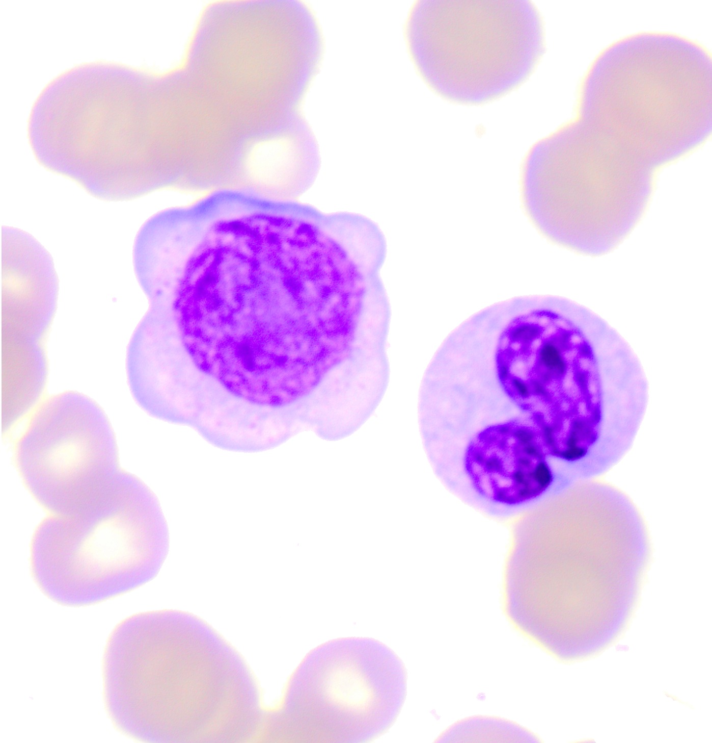 Portal - Leucemia linfoide aguda: subtipo 3 (LLA- L3) Na LLA-L3, os ...