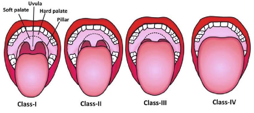Road to CRNA - How does the airway look? The Mallampati... | Facebook
