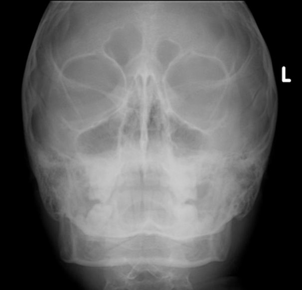 ภูมิแพ้แก้ได้ - Maxillary sinusitis Plain paranasal sinuses radiograph ...