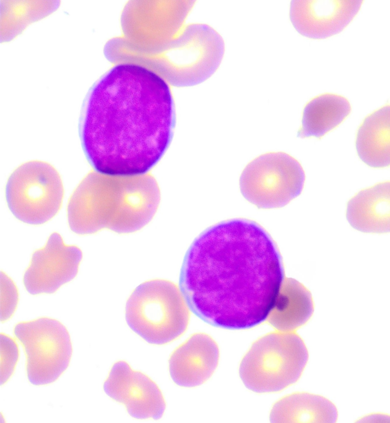 Portal - Leucemia linfoide aguda: subtipo 3 (LLA- L3) Na LLA-L3, os ...
