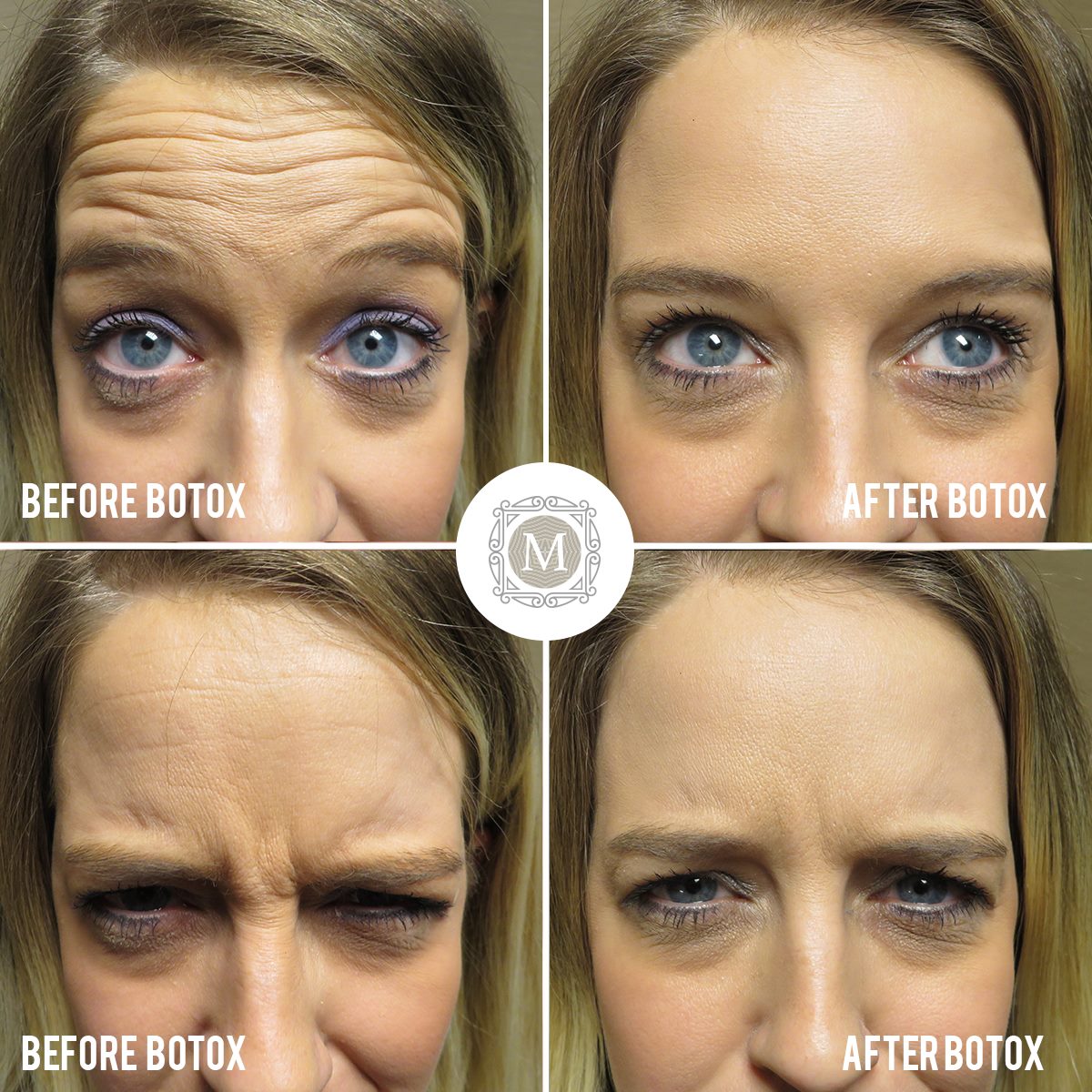 Nouvelle Clinic - BOTOX for your wrinkles! NOW ON...
