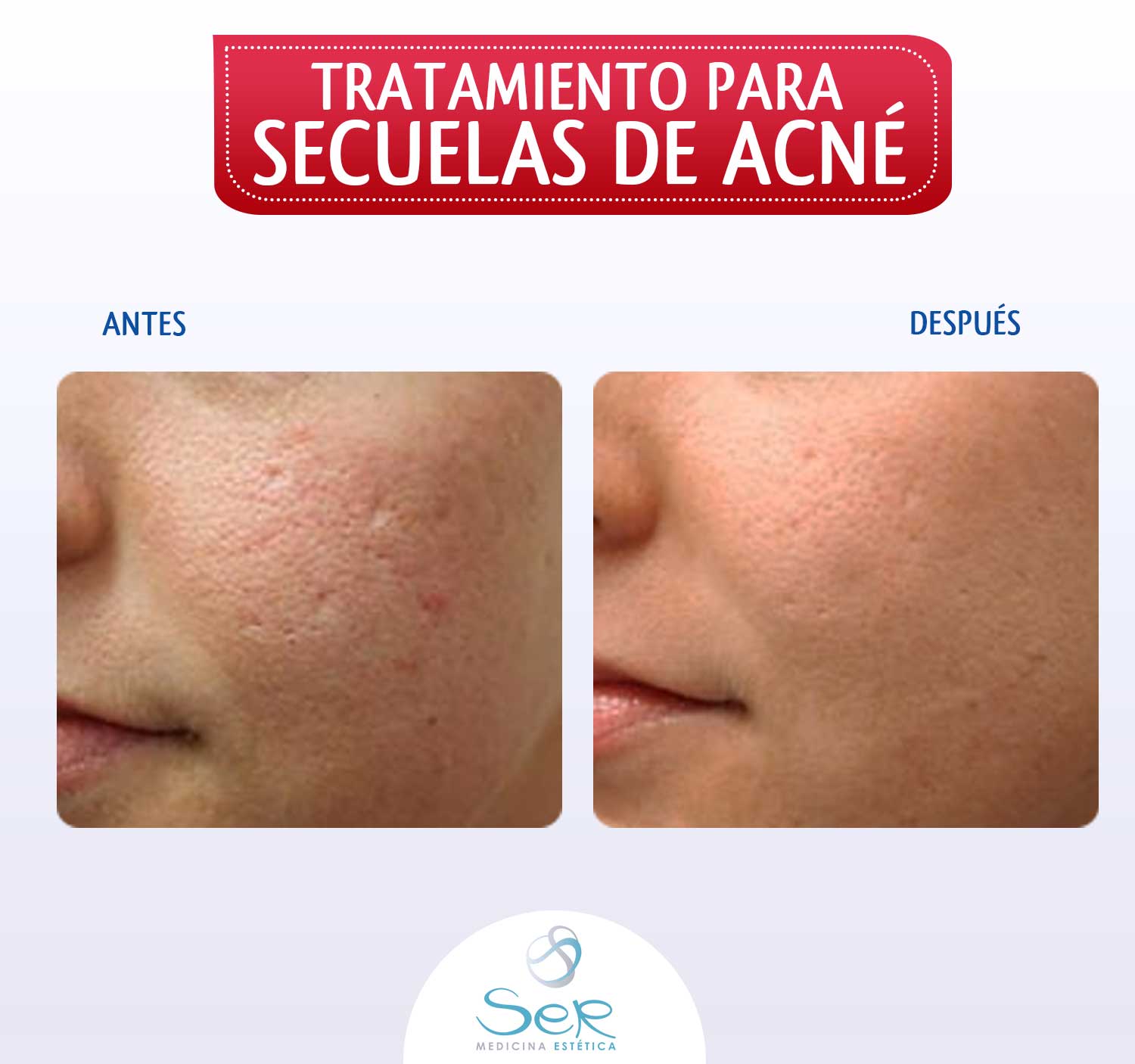 🌷👉El láser BTL EXILITE™ ha... - Medicina Estética SER