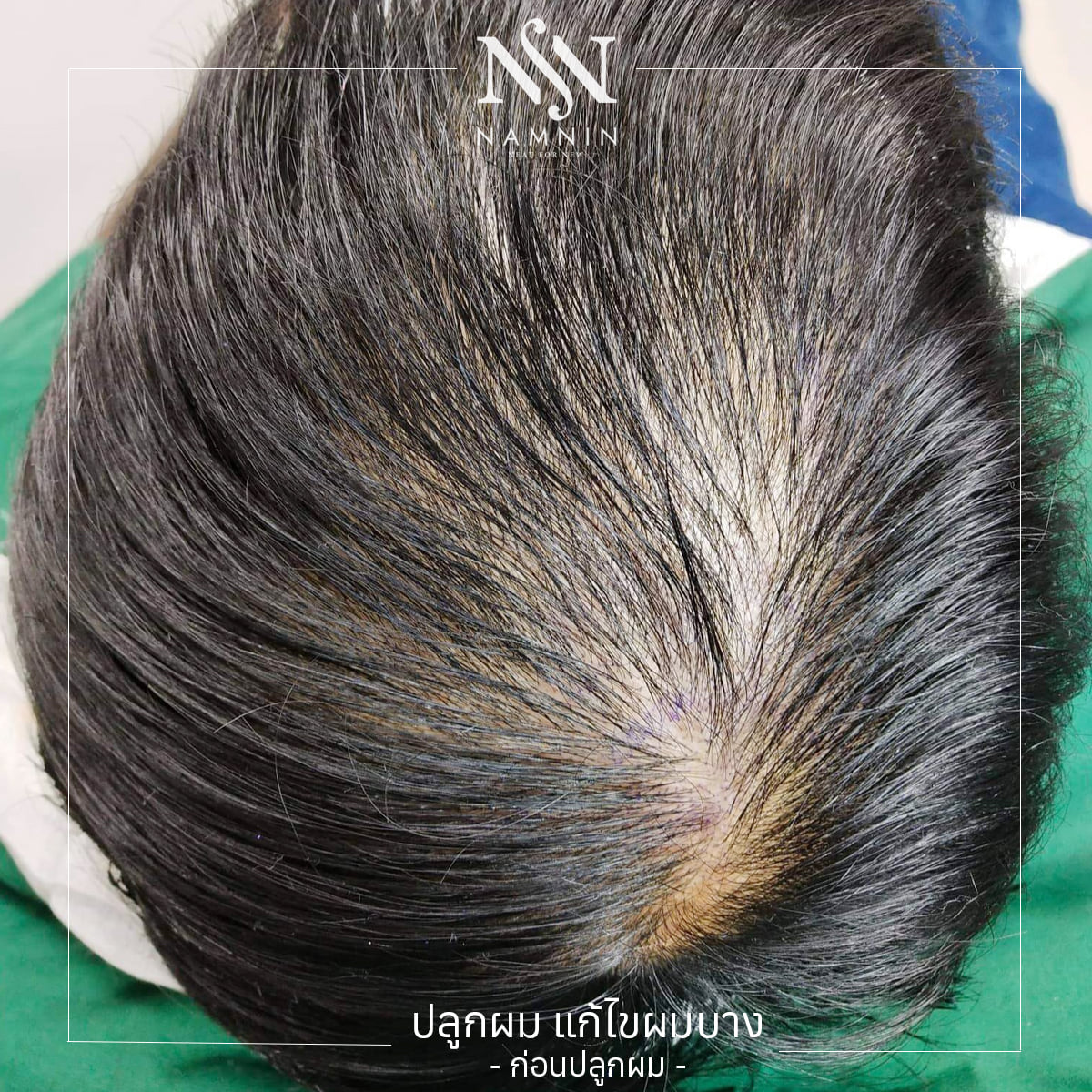Namnin ForV clinic ปลูกผมถาวรเทคนิค NEAT โดยแพทย์ทุกกราฟ | Facebook