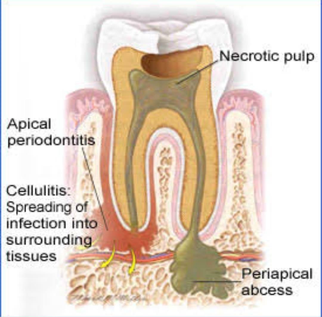 🚦Periapical Abscess 👇👇 Localized... - Green Line Dentistry
