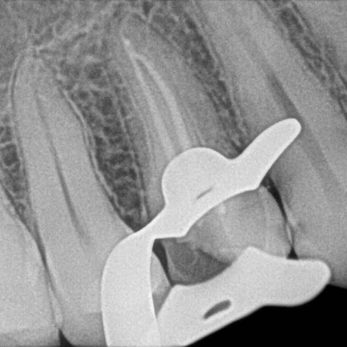 Single visit #Rct... - Golechha Multispeciality Dental Clinic