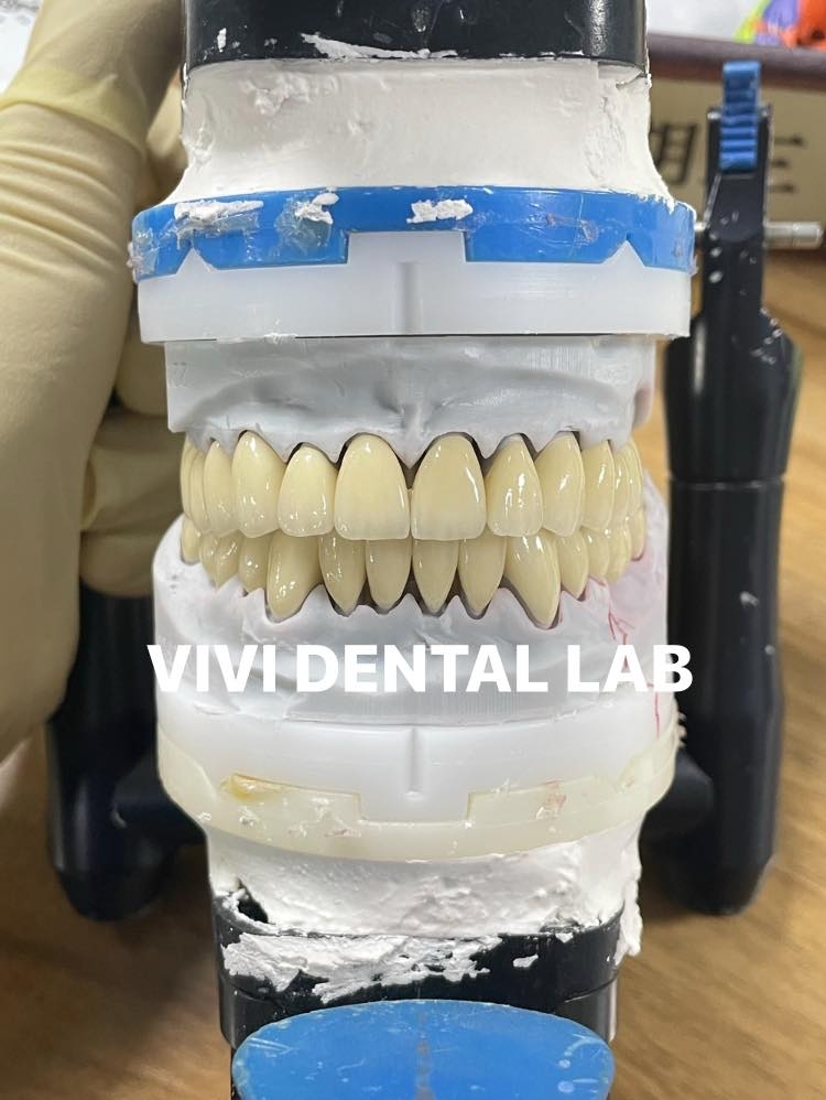 Acrylic denture with pink clasps | China Dental Lab Vivi